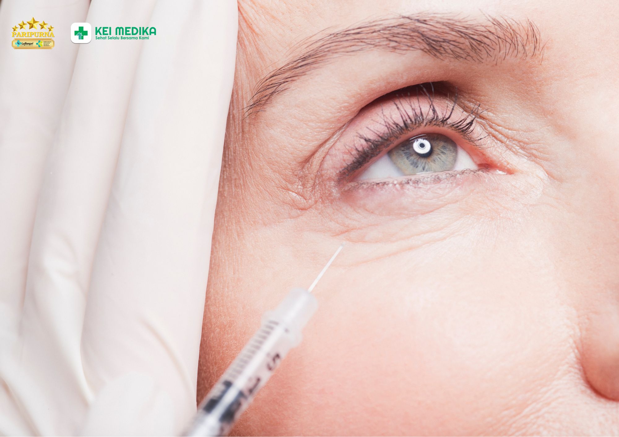 Botox bawah mata untuk kerutan halus di klinik kei medika aesthetic