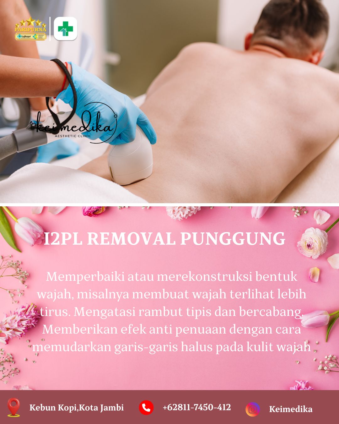 I2PL REMOVAL PUNGGUNG