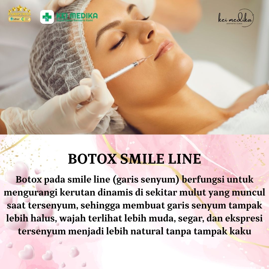 BOTOX SMILE LINE