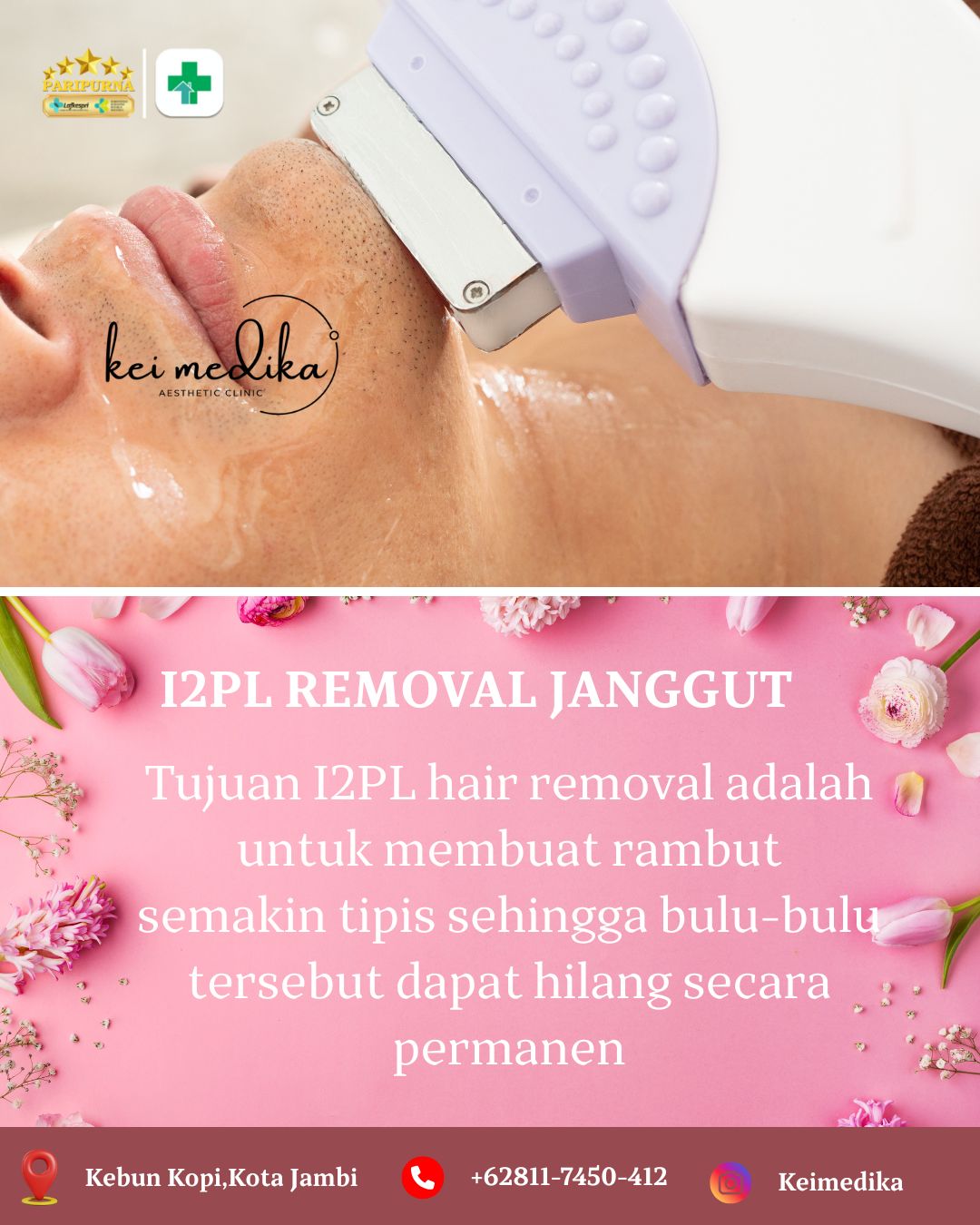 I2PL REMOVAL JANGGUT
