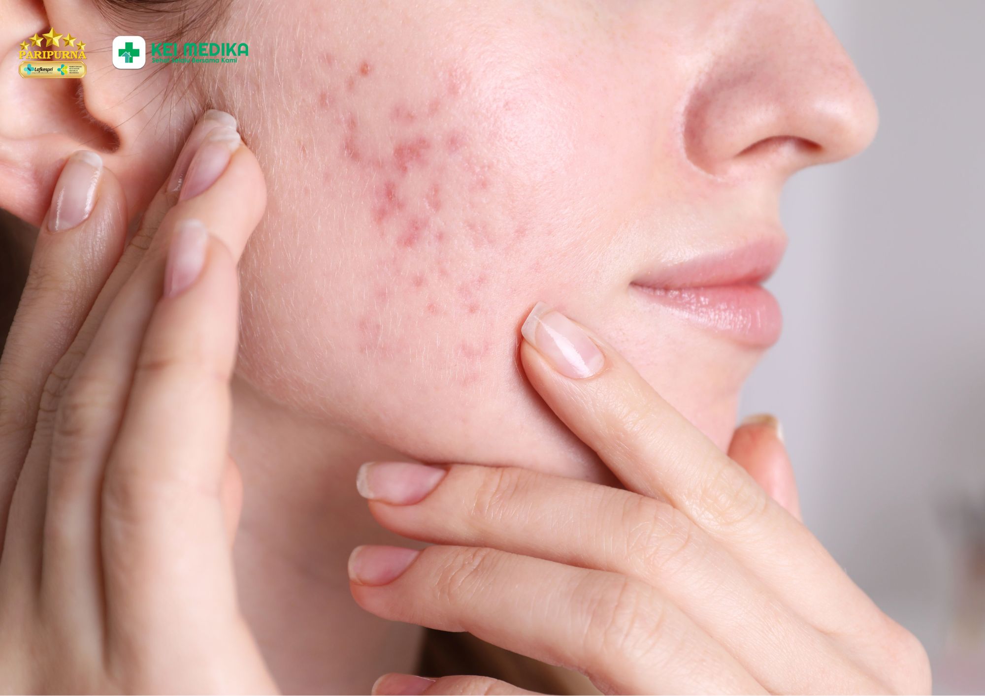 Laser I2PL untuk noda bekas jerawat hormonal