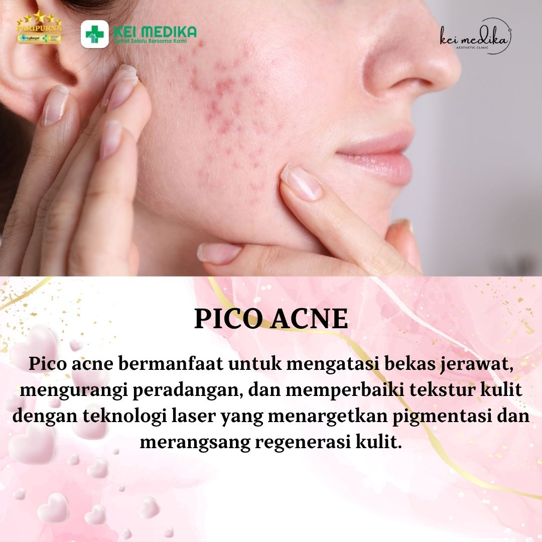 PICO ACNE