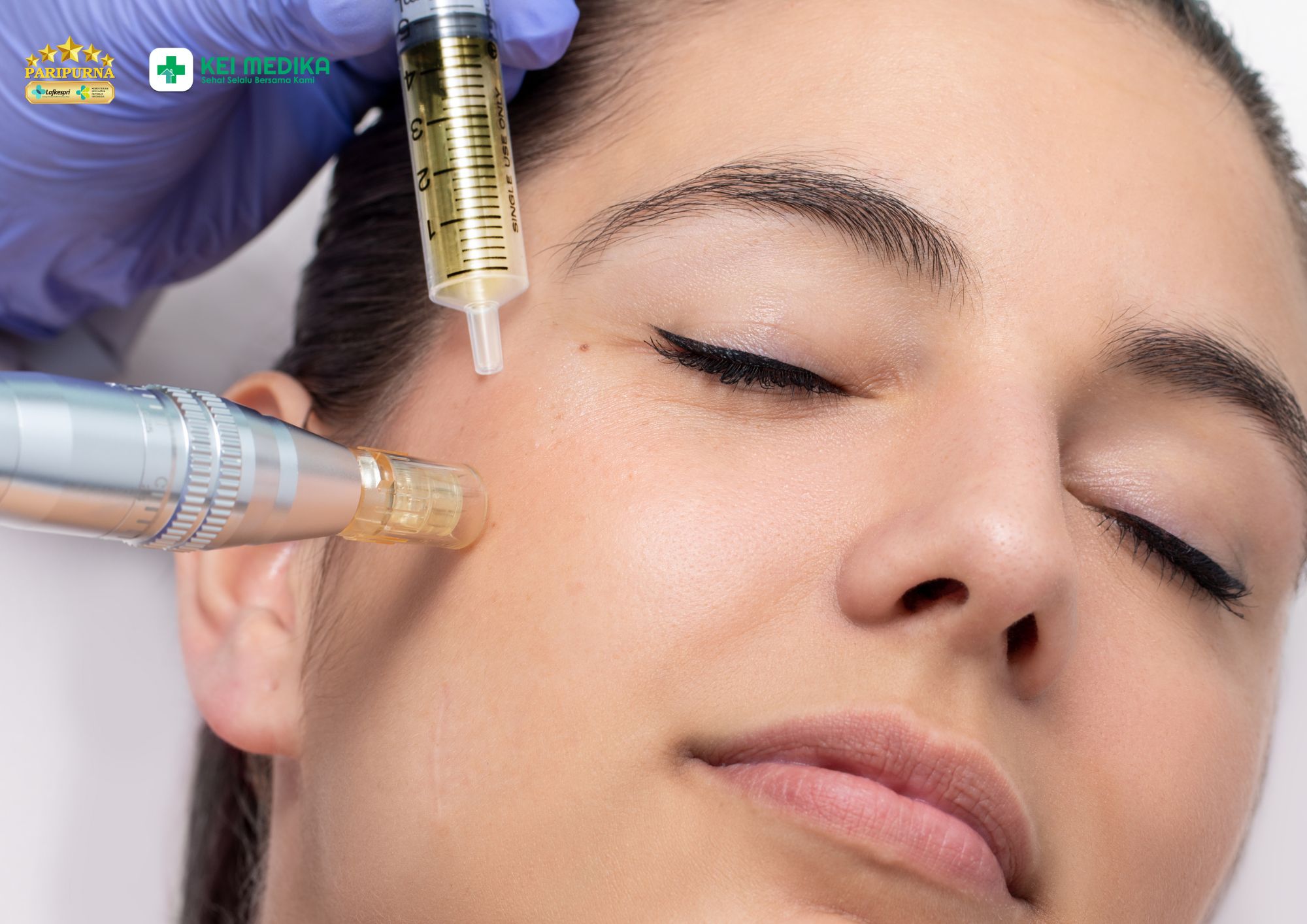 Derma Treatment yang Pas untuk Jerawat Aktif di Keimedika Aesthetic