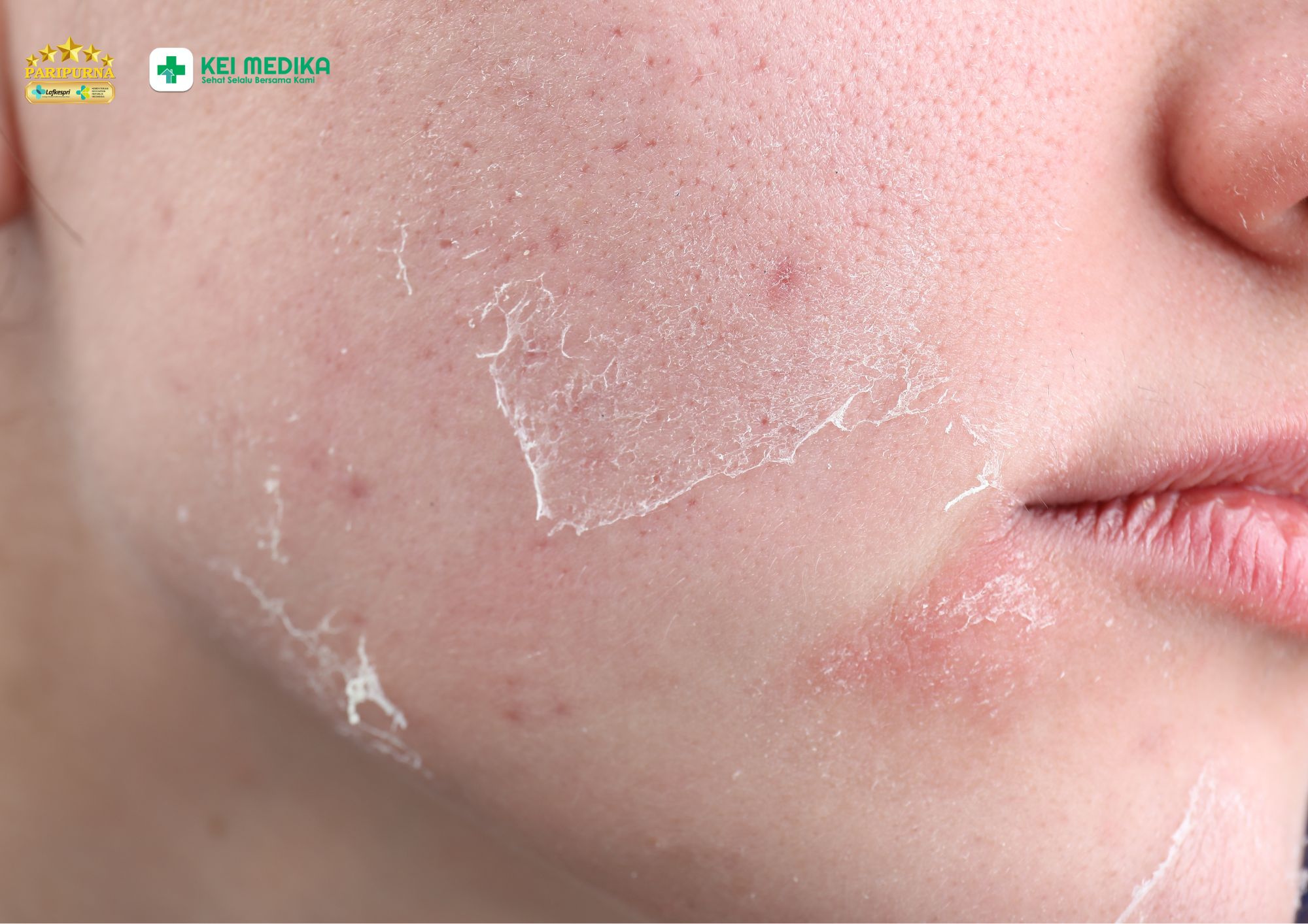 Mengenal Peeling kombinasi retinol dan vitamin C di Klinik Keimedika Aesthetic
