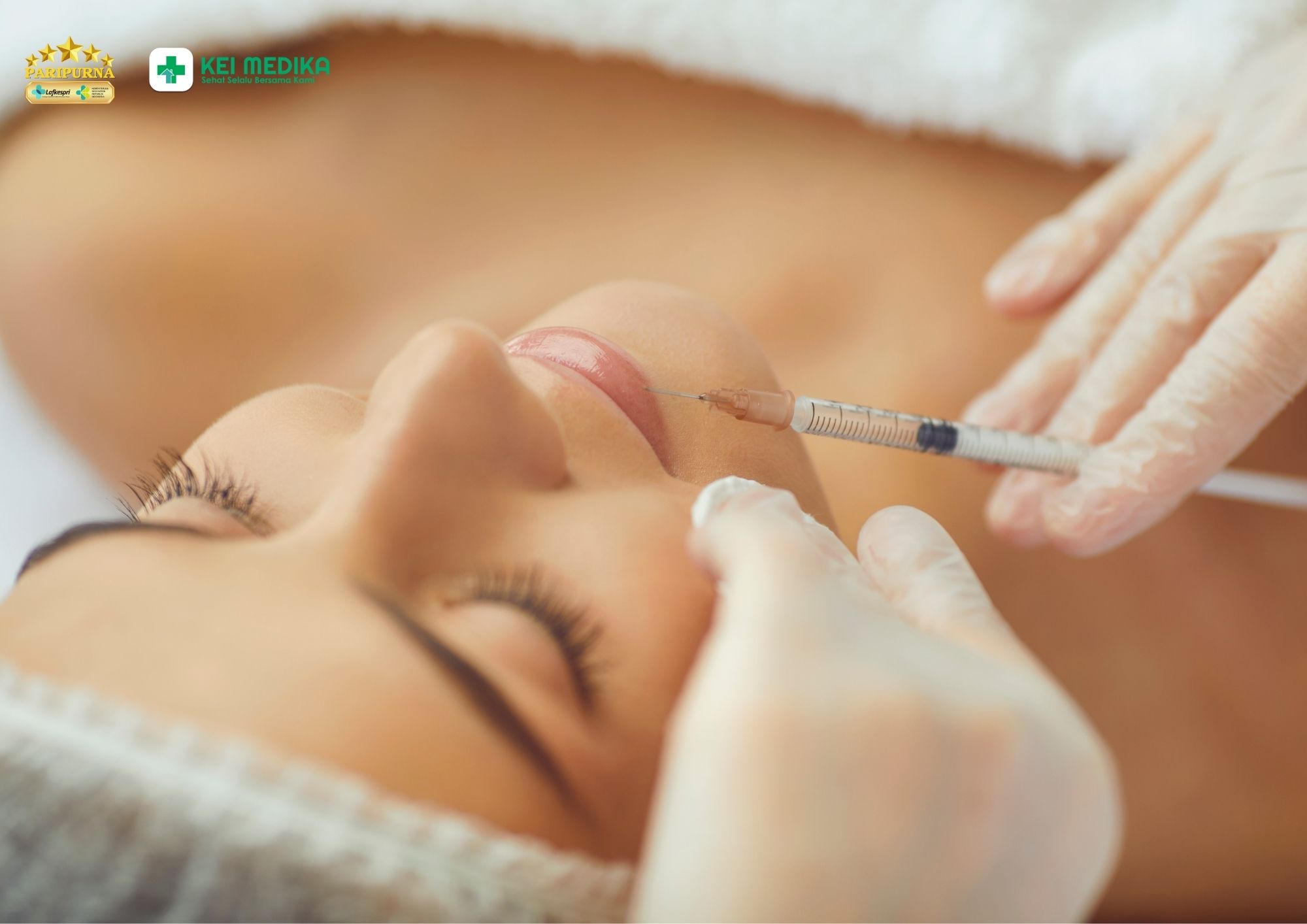 Filler smile line untuk tampilan muda