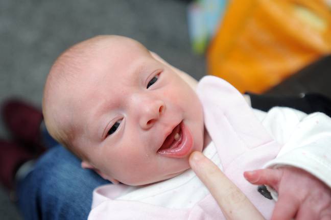 Natal Teeth Kondisi Bayi tumbuh gigi pada saat Lahir