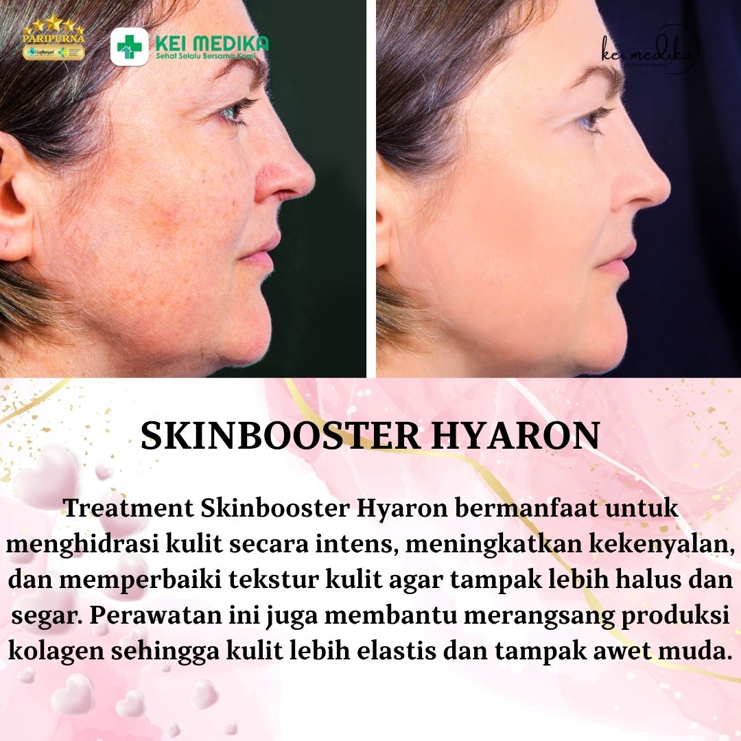 SKINBOOSTER HYARON