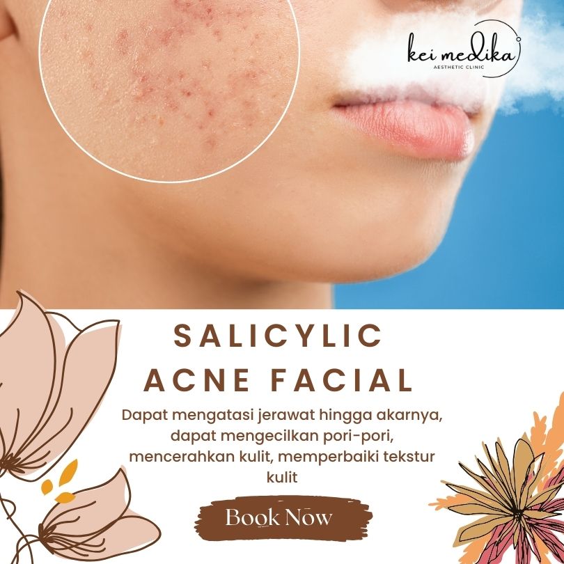 salicylic acne facial 