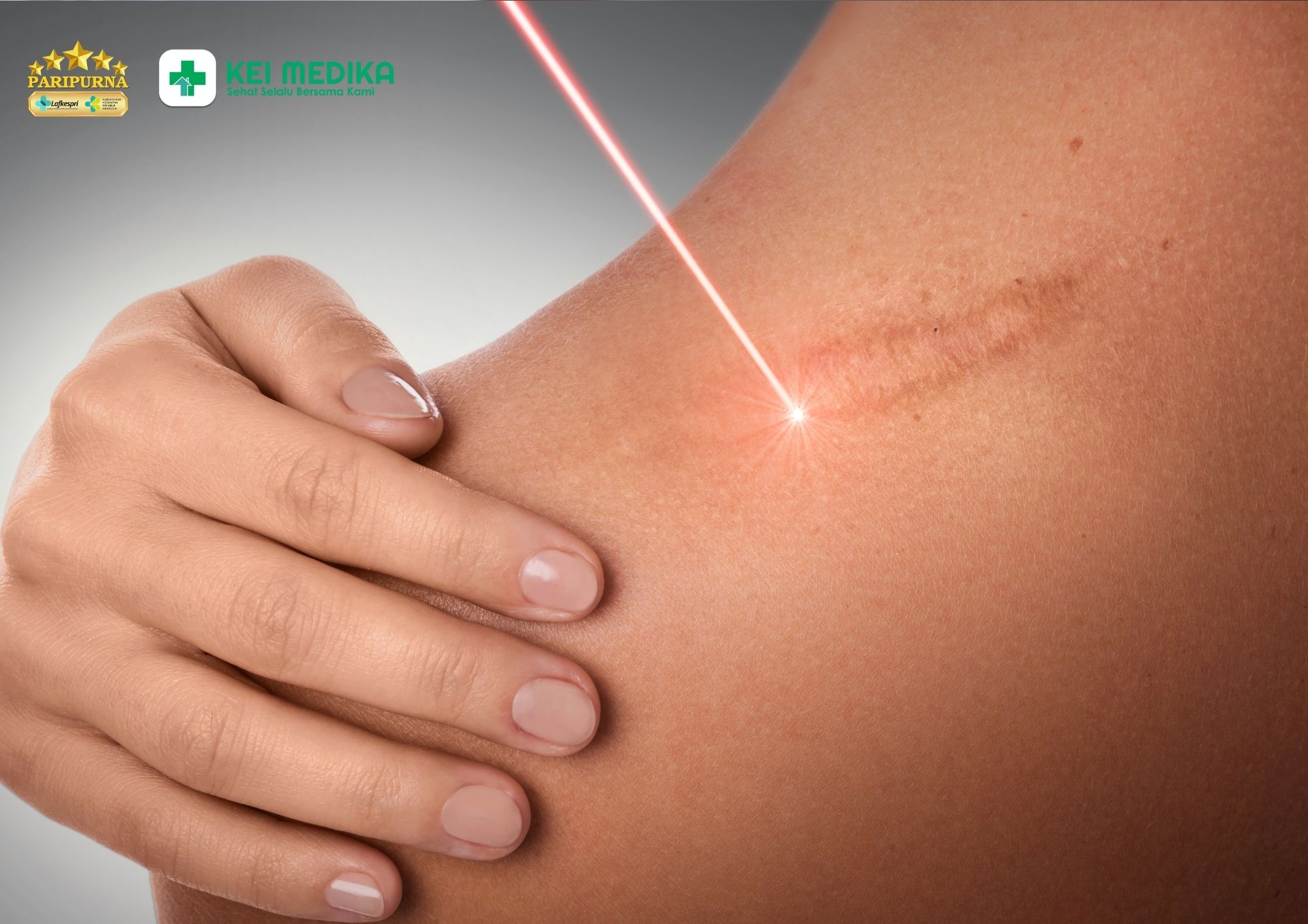 Pilihan laser terbaik untuk bekas luka jerawat