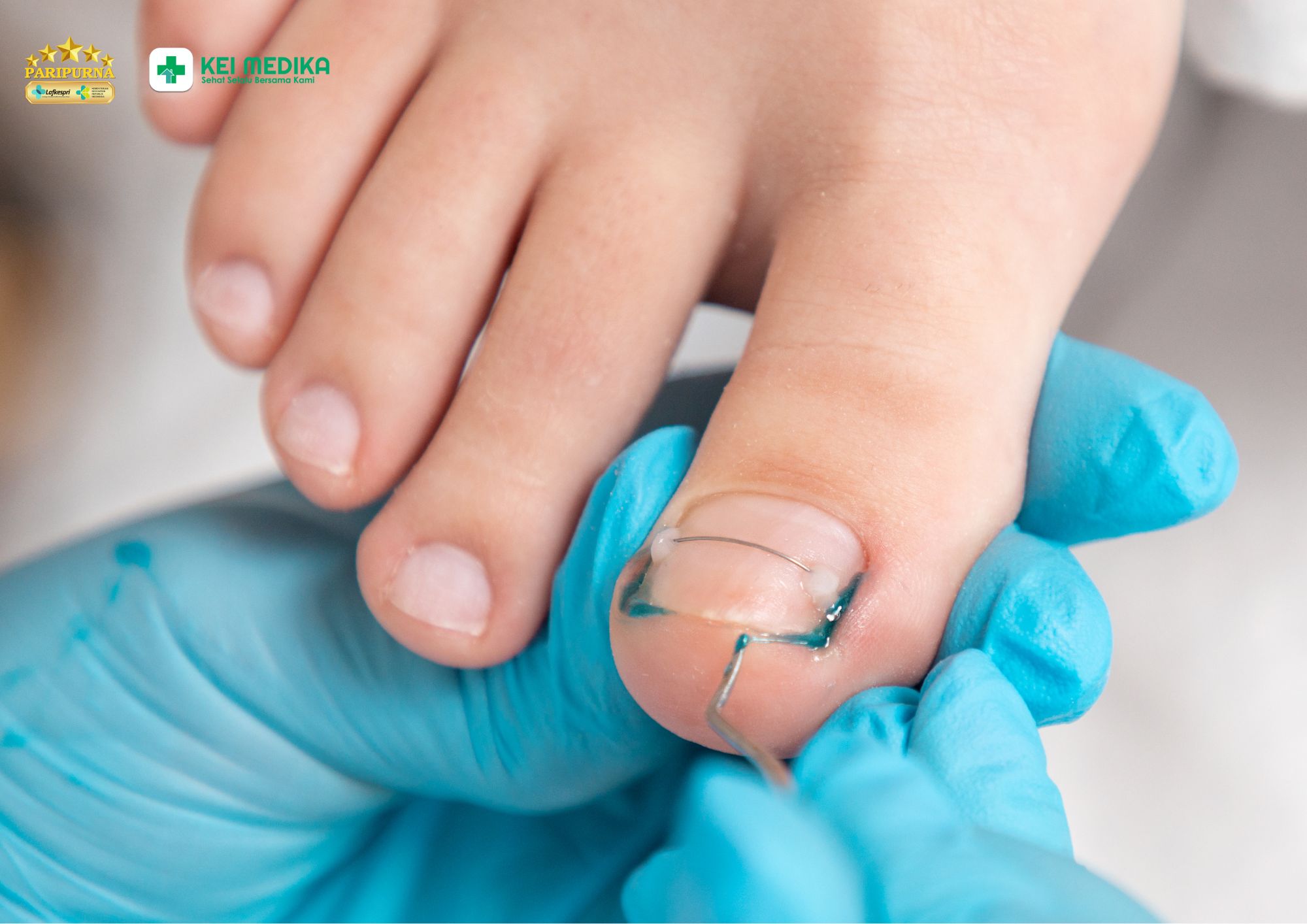 Perawatan kuku kaki untuk penderita diabetes