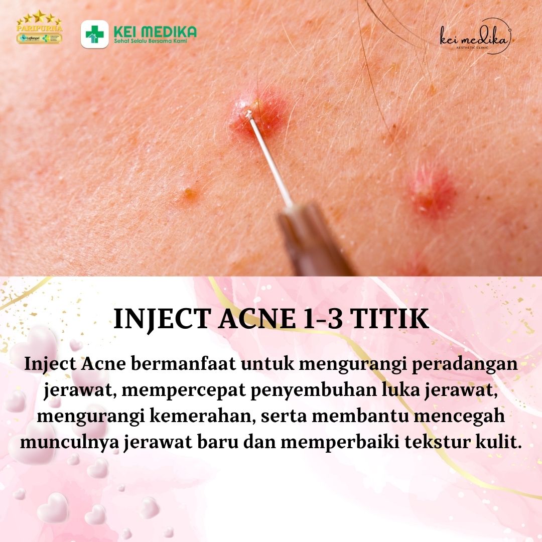 INJECT ACNE 1-3 TITIK