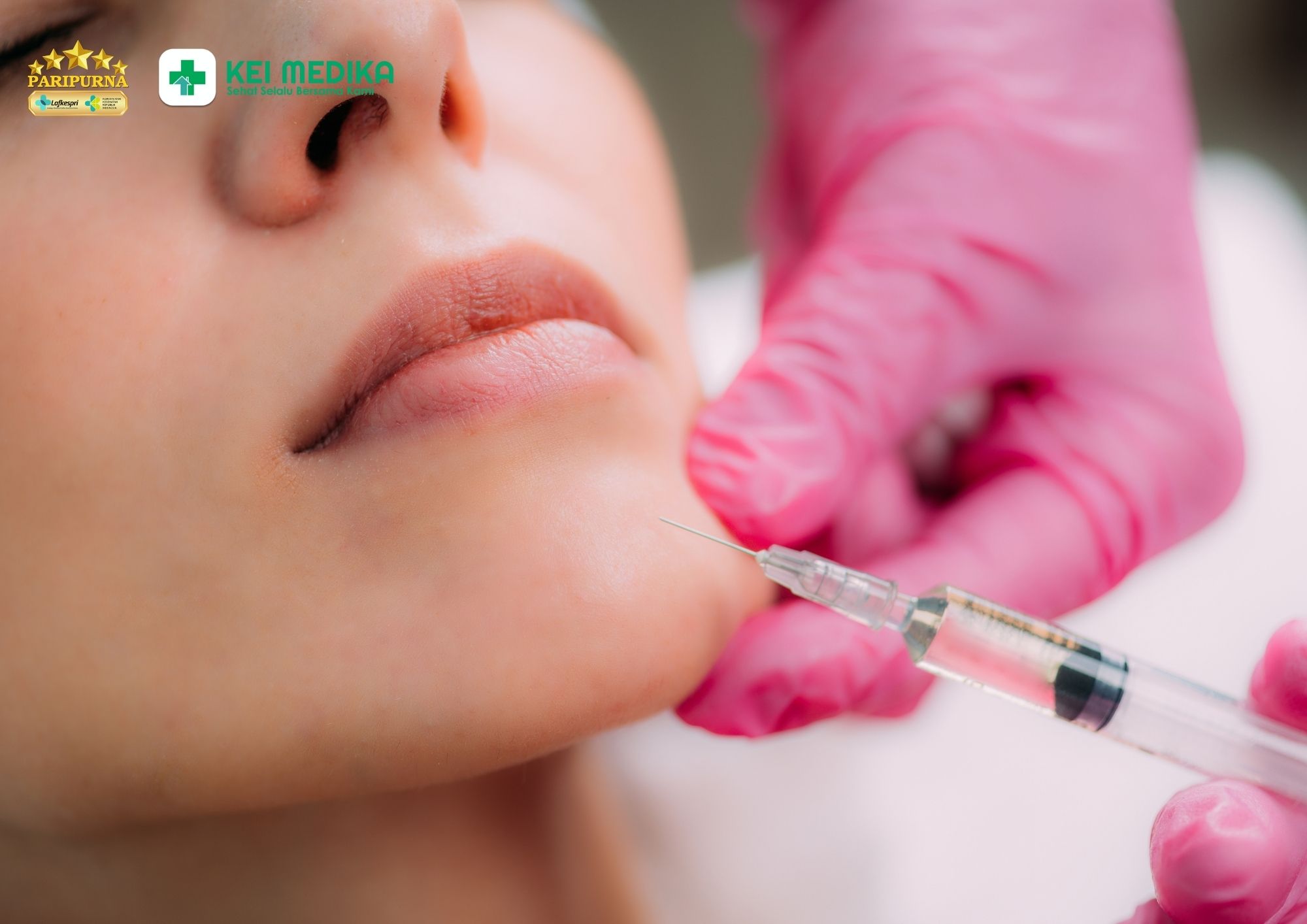 Berapa Lama Efek Filler Bertahan? Ini Penjelasan Dokter Estetik
