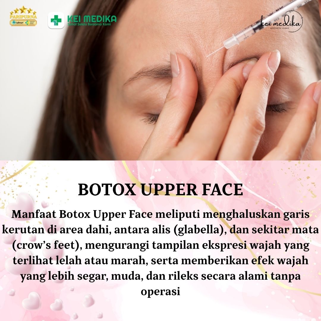 BOTOX UPPER FACE