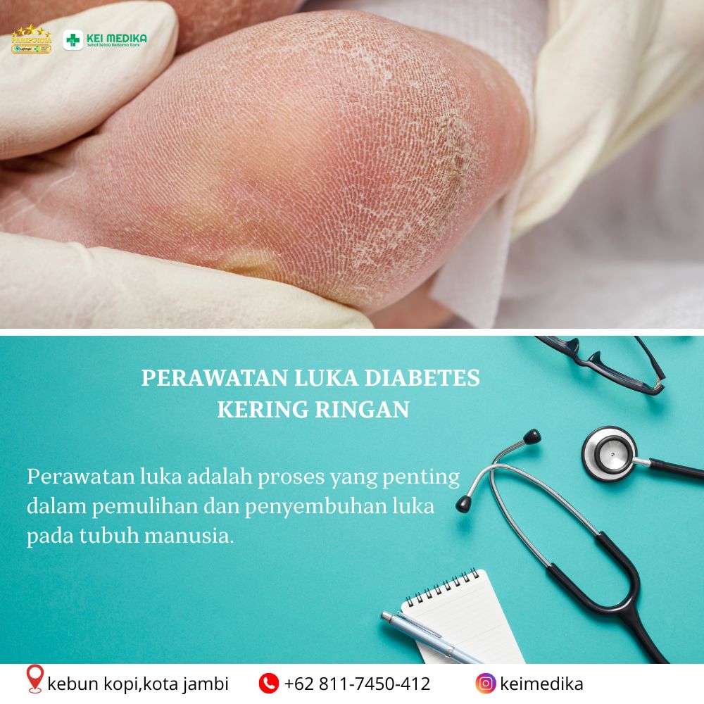  PERAWATAN LUKA DIABETES KERING RINGAN