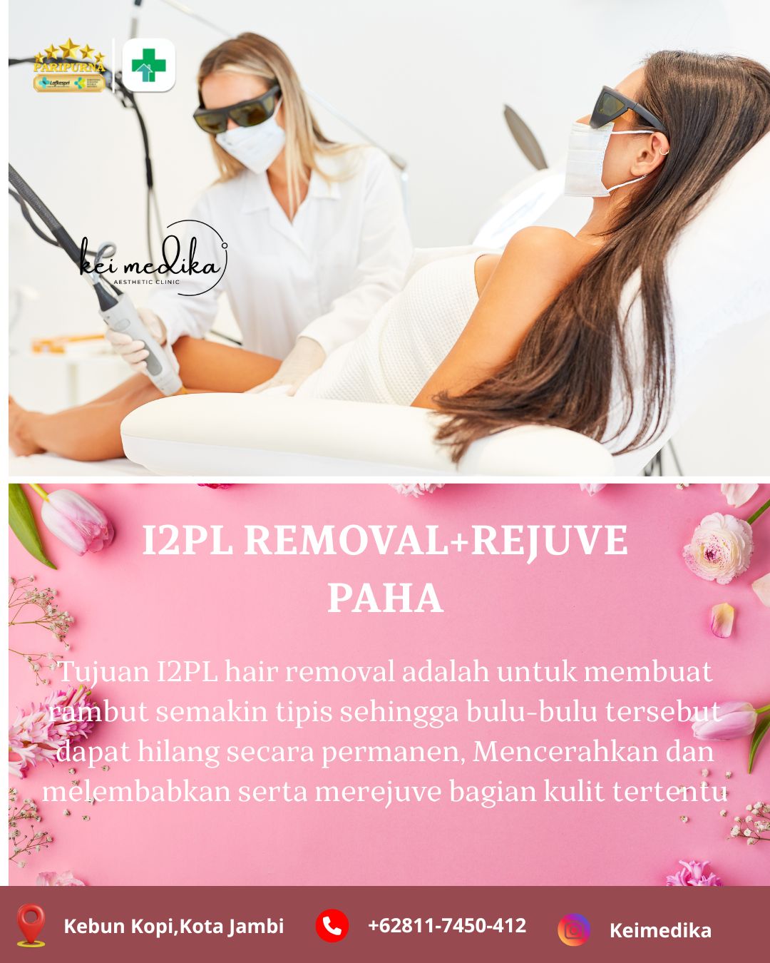 I2PL REMOVAL PAHA