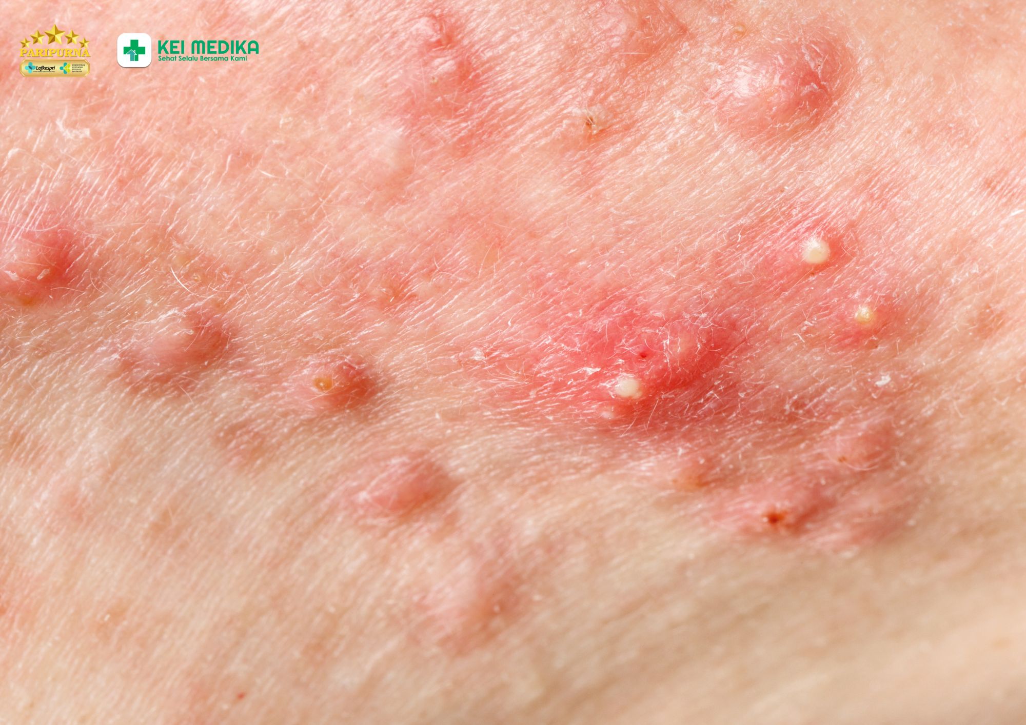 Adapalene untuk Apa? Mengenal Obat yang Sering Digunakan untuk Jerawat