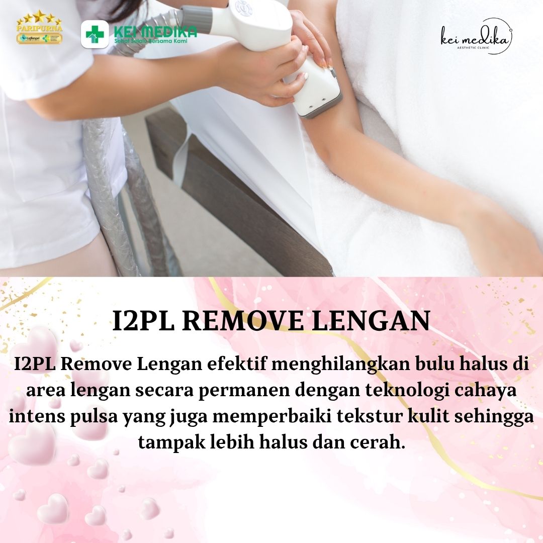 I2PL REMOVAL LENGAN