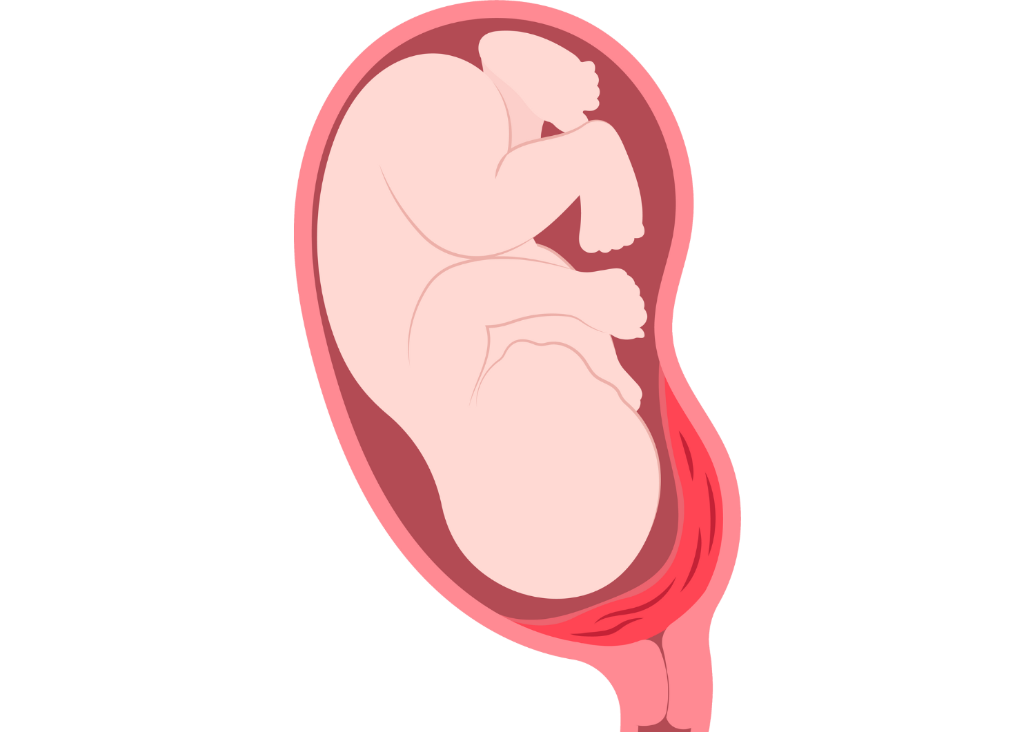 PERSALINAN PRETERM