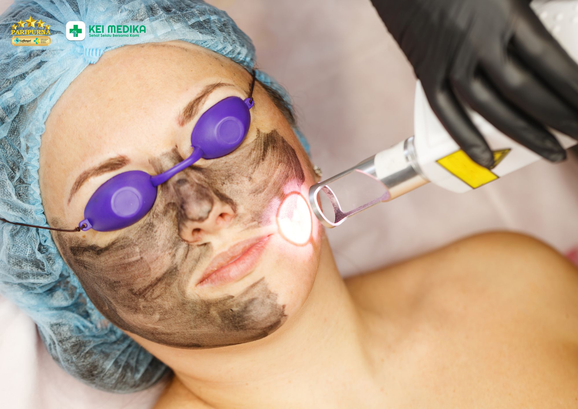 Laser fractional non ablatif